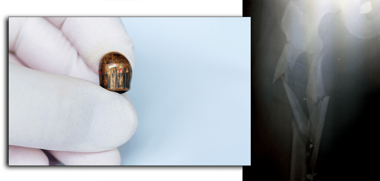 Bullet Compared To Shattered Femur Caused By Bullet